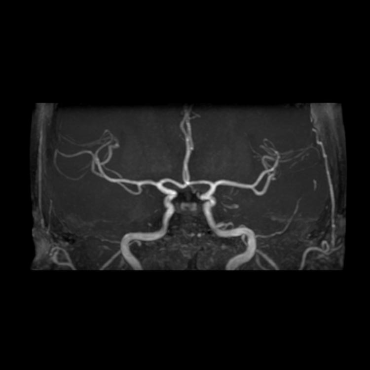 MRI：正常な脳の画像と脳の血管