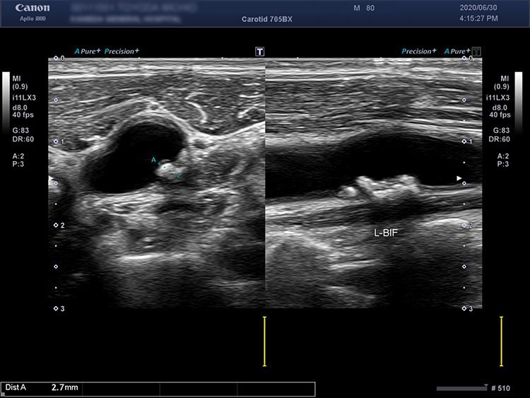 図．脳梗塞を起こした頸部の血管