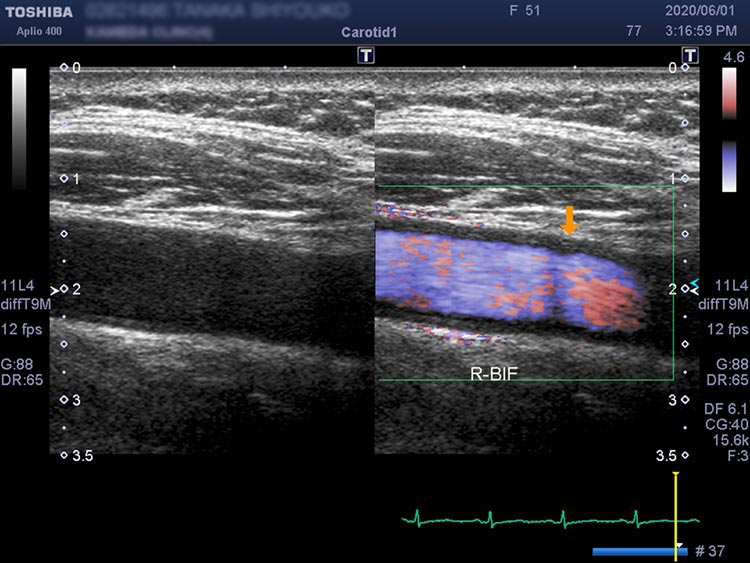 図．正常な頸部の血管
